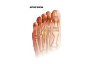 Morton's Neuroma: Causes, Symptoms, and Interventions for Relief