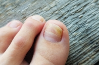 Facts About Fungal Toenail Infections