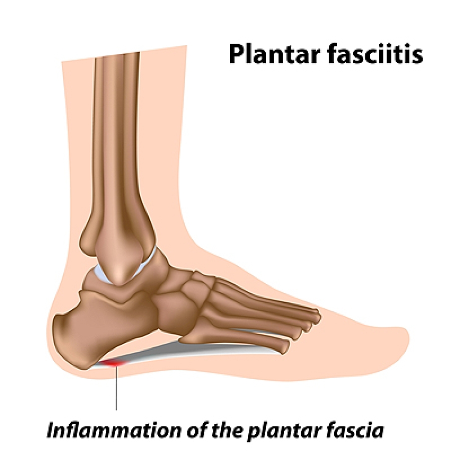 heel inflammation