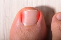 Caring for Your Child’s Ingrown Toenail