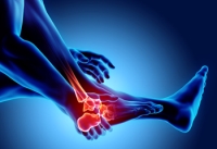 Early Signs of Arthritis