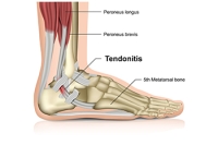 Symptoms of Achilles Tendonitis in Runners