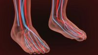 How Is Peripheral Artery Disease Diagnosed?