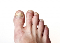 How to Best Treat a Toenail Infection